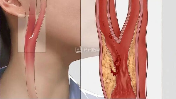 真实案例丨3个月左颈动脉狭窄降低约27%，是怎么实现的？