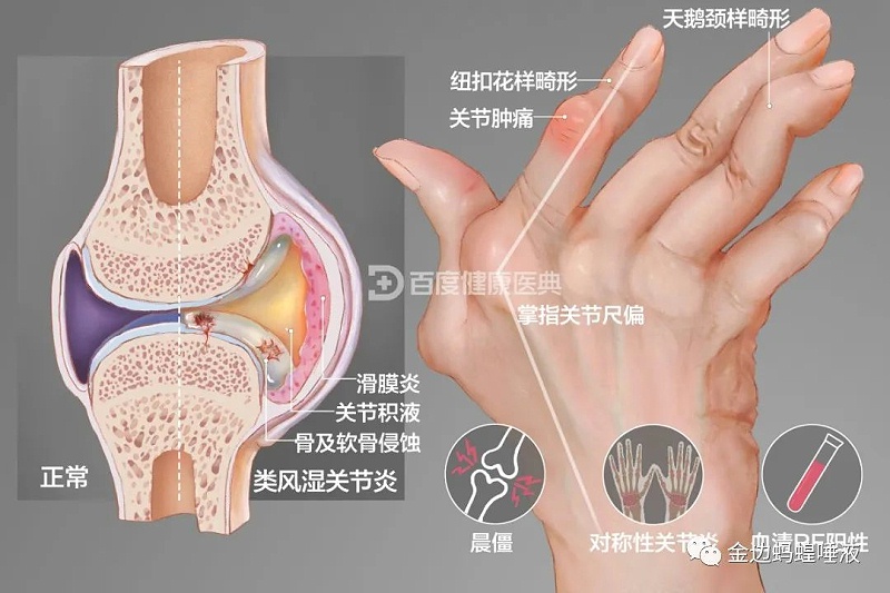 壮医水蛭疗法,天然水蛭素胶囊