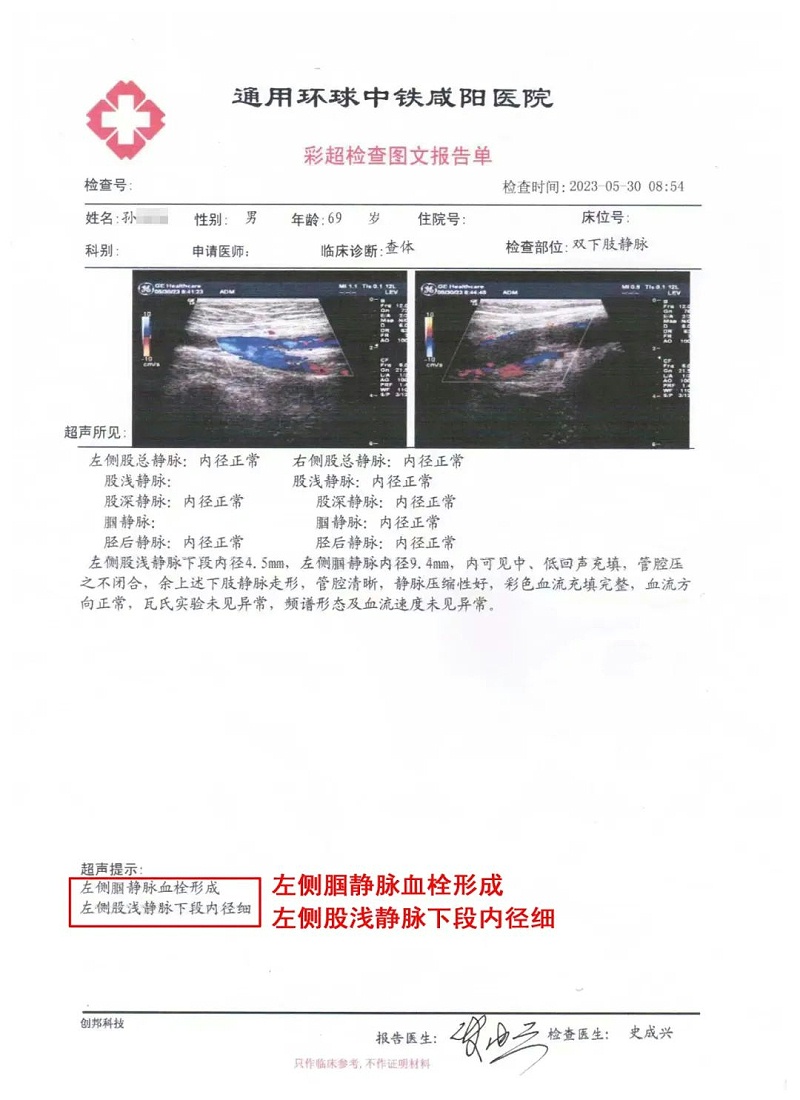 水蛭素、静脉斑块、血栓